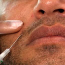 Dermal Fillers