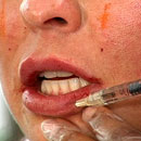 Dermal Fillers