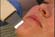 The Ultimate Ultrasonic Facial