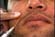 The Complete Guide to Dermal Filler Injections
