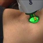 Laser Hair Removal Techniques