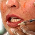 Dermal Filler Courses