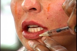 Dermal Filler Injections