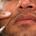 Restylane Injections