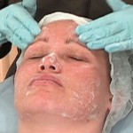 Chemical Peel Video