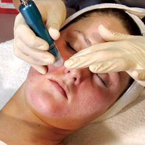 aesthetician-training-acne-oily-skin, microdermabrasion-treatments-video-dvd