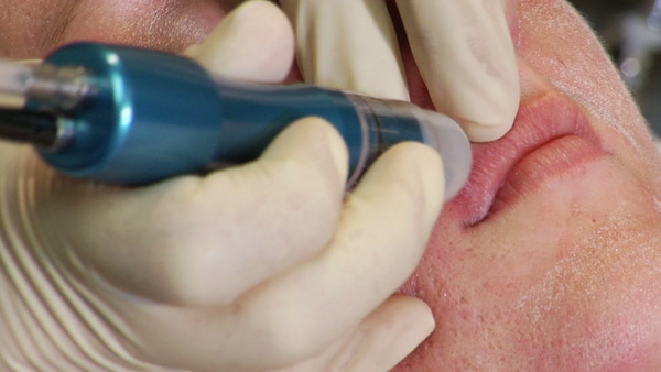 Crystal microdermabrasion for the upper lip: anti-aging esthetician class for oily skin professional spa application.